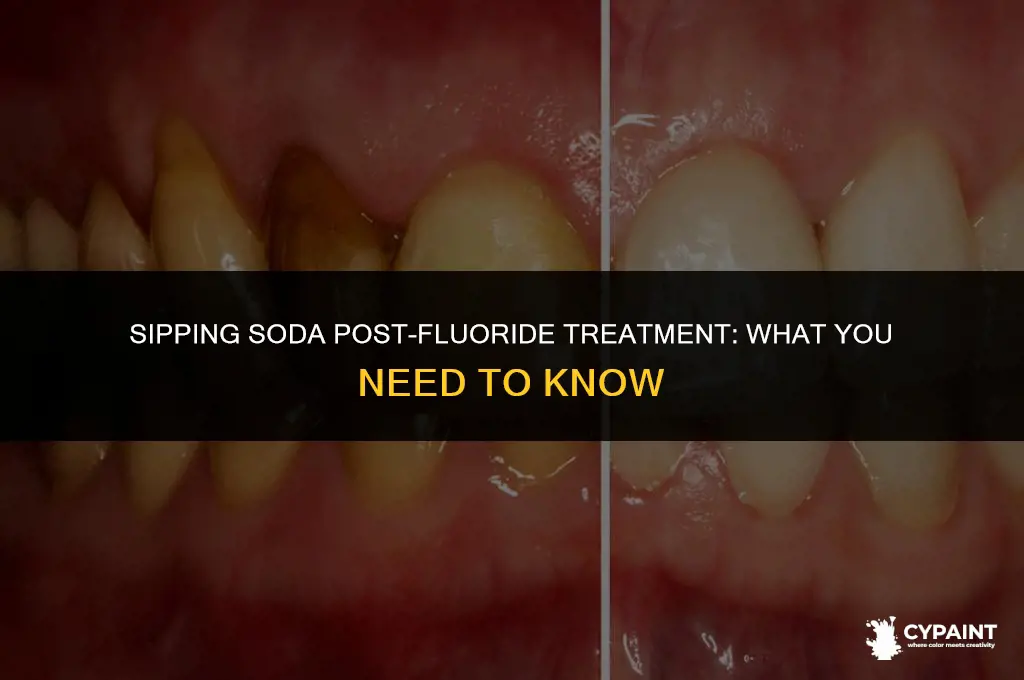 can i drink soda after painted fluoride treatment