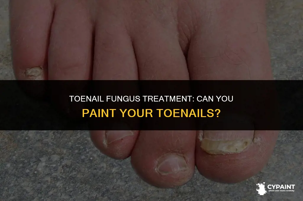 can i paint my toenails while treating fungus