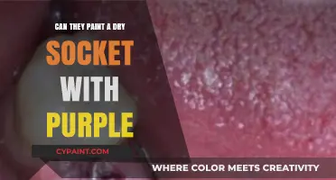 Exploring Dental Artistry: Can They Paint a Dry Socket Purple?