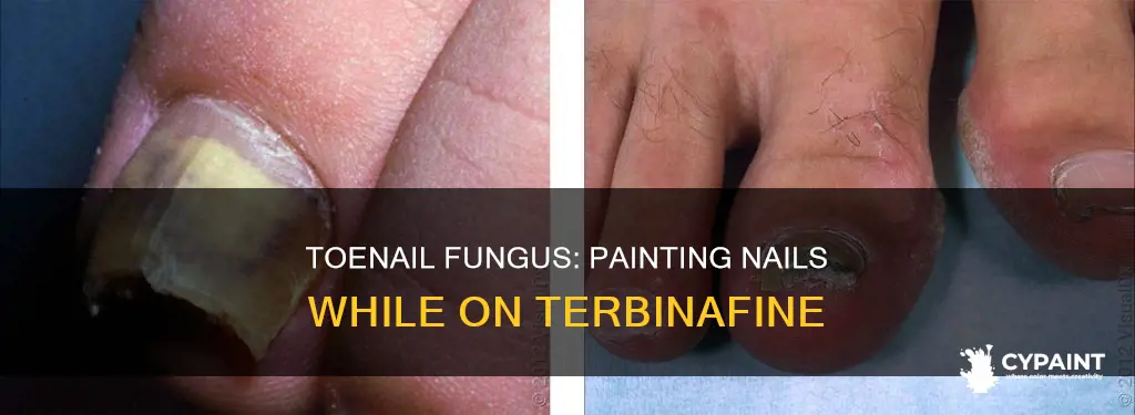 can you paint the infected toenails while taking terbinafine