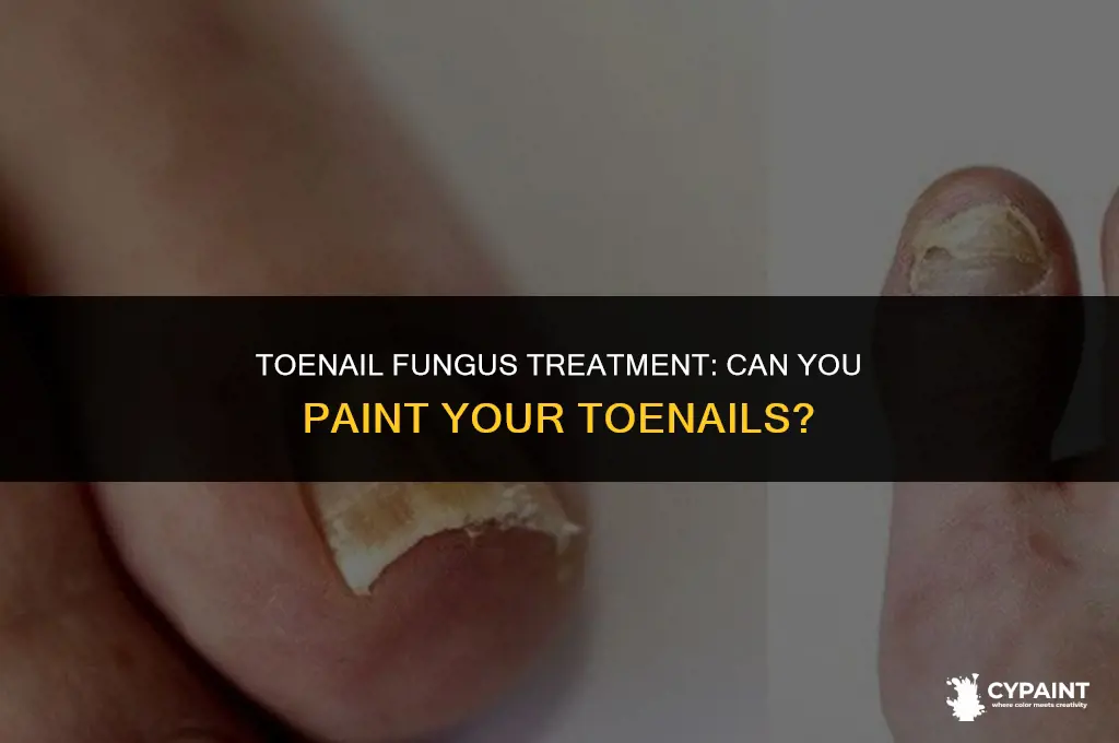 can you paint your toenails while treating fungus