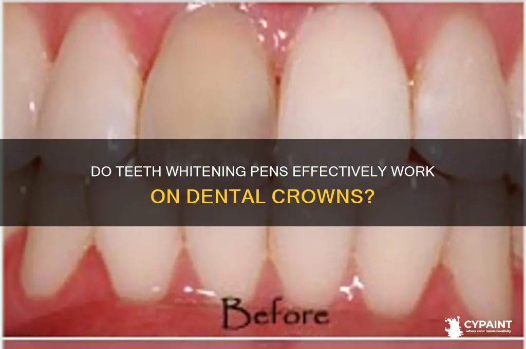 does teeth paint pens work on crowns
