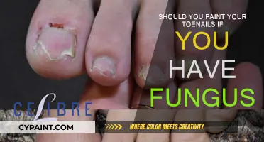 Toenail Fungus: Is Painting Your Nails a Good Idea?