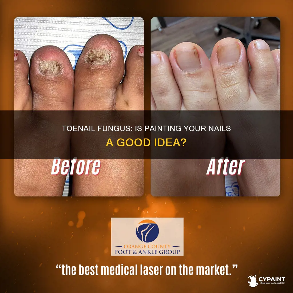 should you paint your toenails if you have fungus