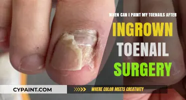 Toenail Care Post-Surgery: When Can I Paint My Toenails Again?