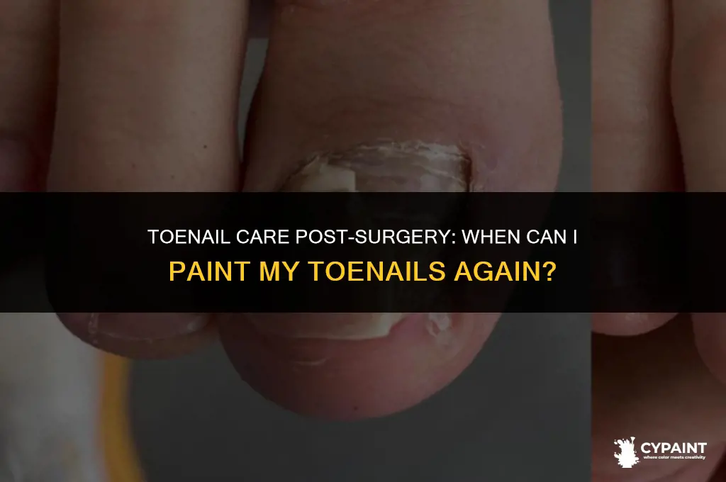 when can i paint my toenails after ingrown toenail surgery